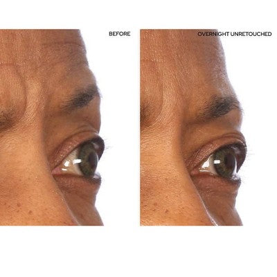 SiO Beauty Super-Lift Pack - Reusable Anti-Wrinkle Patches for Face (5 Patches)